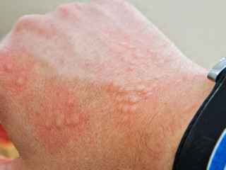 Övrə və övrəyəbənzər səpkilərin differensiyası